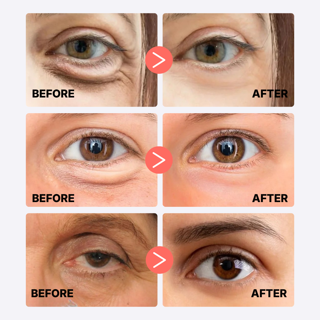 MicroLift™ Under-Eye Patches by ALECARE | Instant Lift. Lasting Youth.